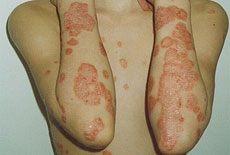 Psoriasis vulgaris - v den nástupu